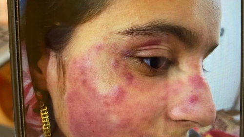 بهبود بسیار جالب قارچ درماتوفیت پوست صورت در بیمار یازده ساله